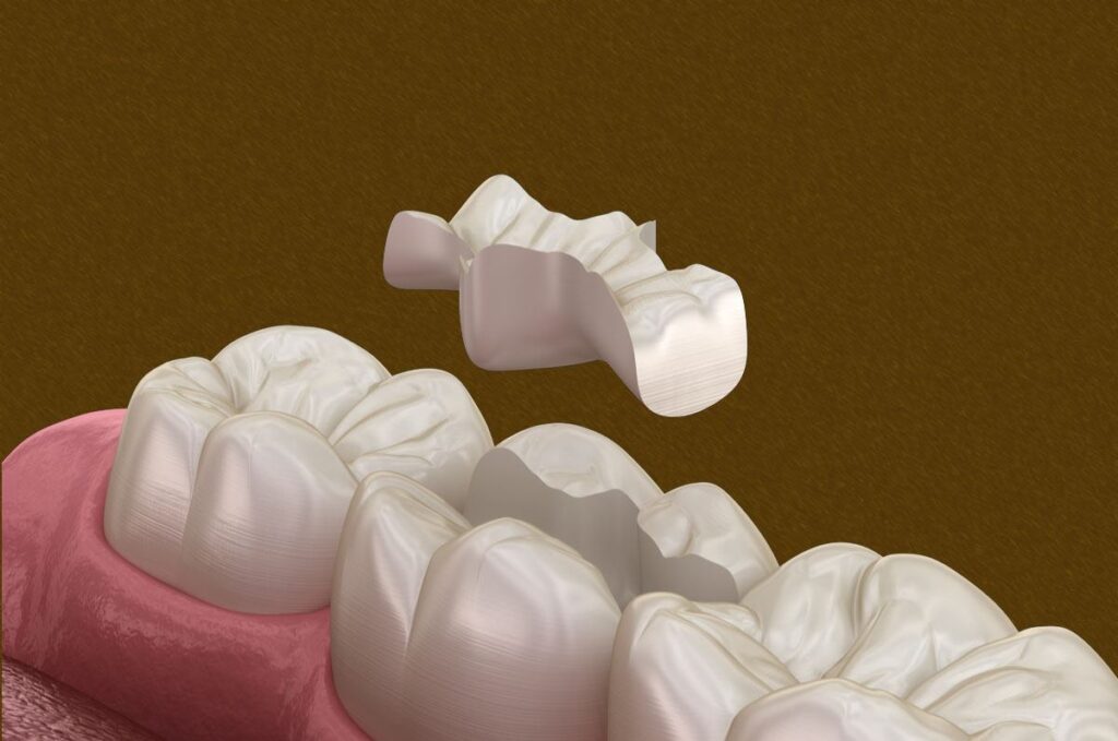 incrustaciones dentales