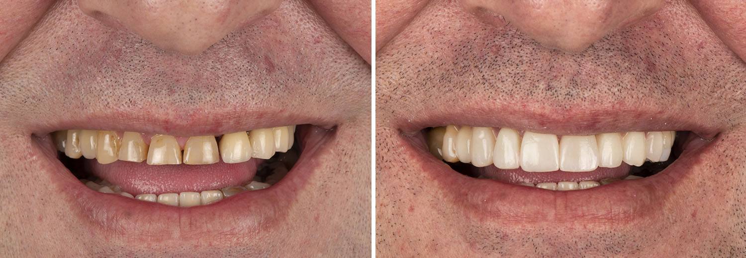 Carillas de porcelana combinadas con implantes